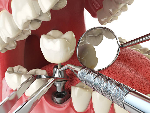 Best Emergency Dentist for Knocked-Out Tooth in Dickinson, ND